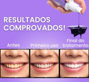 Clareador Dental Smile - Dentes Brancos Em Segundos