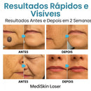 Caneta Laser MediSkin™ – Remove Manchas, Verrugas e Sinais Sem Dor