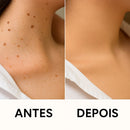 Caneta Laser MediSkin™ – Remove Manchas, Verrugas e Sinais Sem Dor