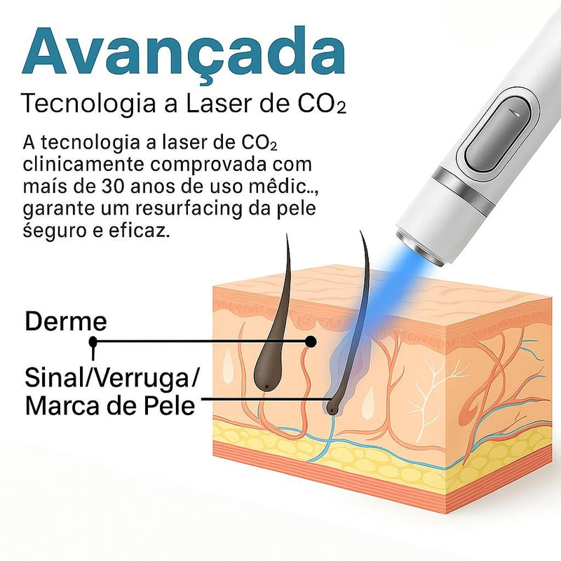 Caneta Laser MediSkin™ – Remove Manchas, Verrugas e Sinais Sem Dor
