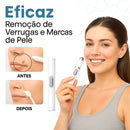 Caneta Laser MediSkin™ – Remove Manchas, Verrugas e Sinais Sem Dor