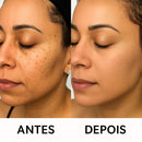 Caneta Laser MediSkin™ – Remove Manchas, Verrugas e Sinais Sem Dor