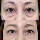 Face lift rejuvenescedor instantâneo